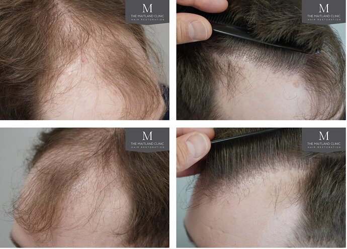 The Maitland Clinic - 2027 grafts by FUE photo