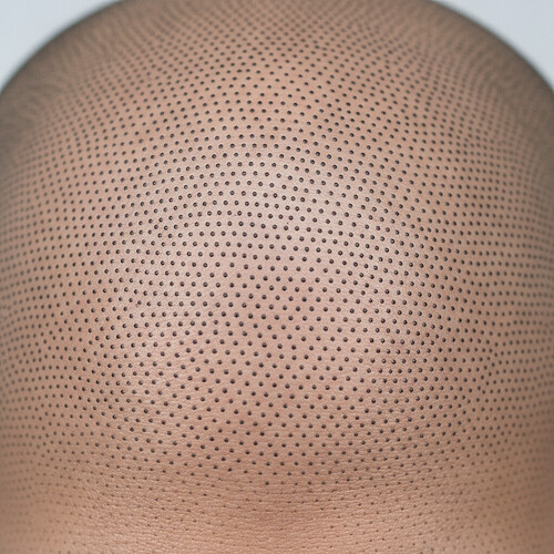 Scalp Micropigmentation (SMP): A Non-Surgical Alternative/Addition to Hair Transplants