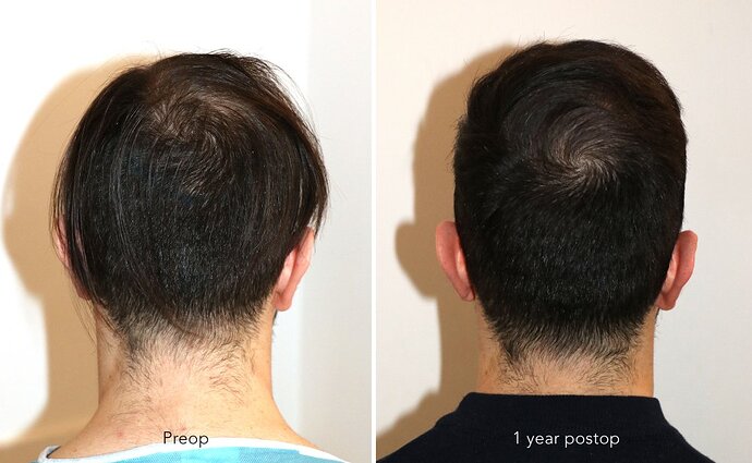 Case performed by Dr. Feriduni – 3744 FU in 1 procedure photo