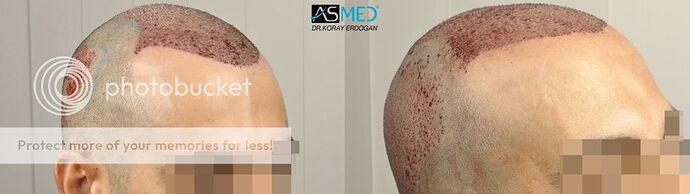 Dr Koray Erdogan, ASMED Clinic - Twin brothers' operations - 3200 grafts FUE / 4300 grafts FUE photo