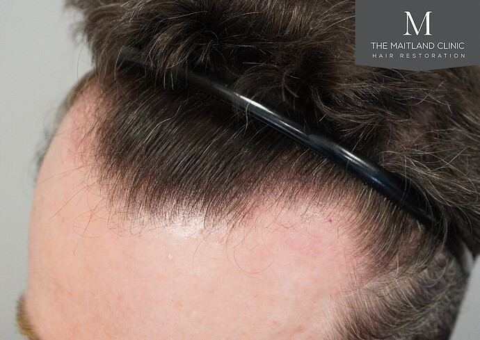 Before and after results: 1694 grafts by FUE at The Maitland Clinic (Dr Edward Maitland Ball) photo