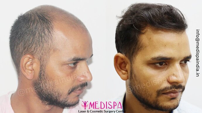 Dr. Suneet Soni - 5294 Grafts, Combine FUT + FUE + Beard Technique, NW- VI, 2 Years Result photo