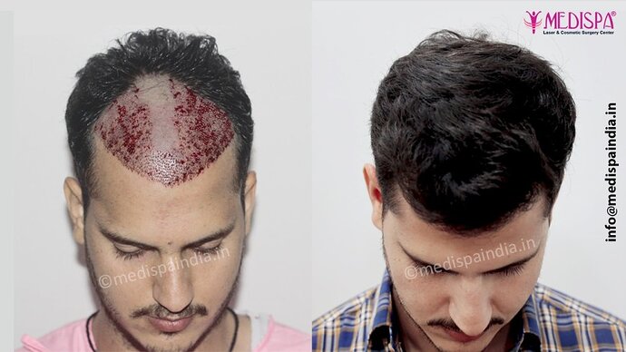 Dr. Suneet Soni - 2500 FUE Grafts, NW- III photo