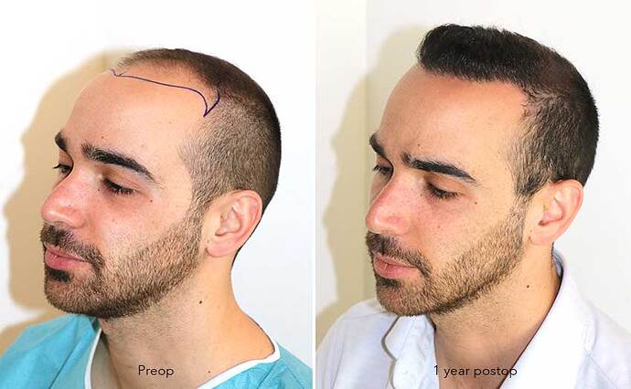 Case performed by Dr. Feriduni – 3505 FU in 1 procedure photo
