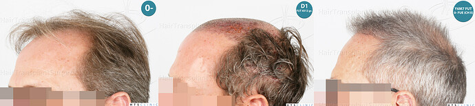 Dr Devroye + Dr Montesanti + Dr Jenard / 7015 grafts (4512 FUT + 2503 FUE) / 2 sessions photo