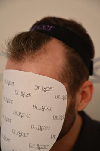 Ozlem Bicer MD-2340 Grafts FUE by micro-motor, 12. month result  photo