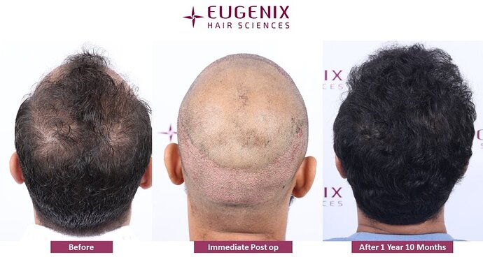 Eugenix Hair Sciences Clinic | Norwood Grade 3 | 22 Months Hair Transplant Results| photo