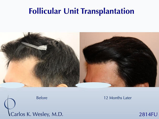 #BAM Stronger, Healthier Hairline (2814 FUT grafts): Carlos K. Wesley, M.D. (NYC & LA) photo