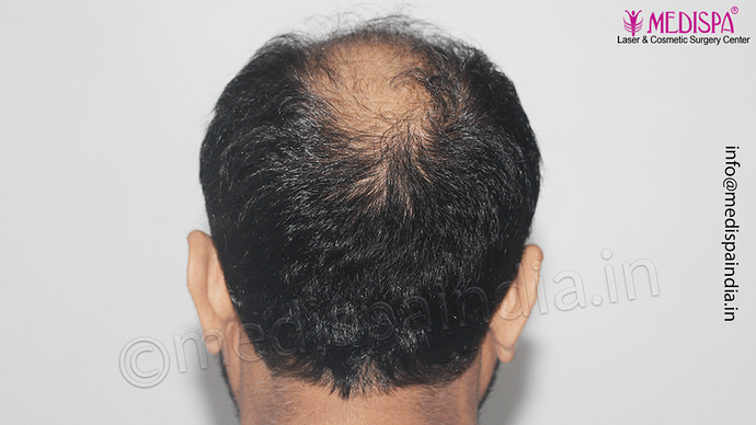 Dr. Suneet Soni - 5334 Grafts, Combine FUT + FUE + BHT (Beard) Technique, NW- V photo