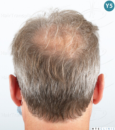 Dr Devroye + Dr Montesanti + Dr Jenard / 7015 grafts (4512 FUT + 2503 FUE) / 2 sessions photo