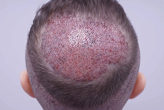 FUE Hair Transplant - 2,300 Grafts - Dr Bessam Farjo photo