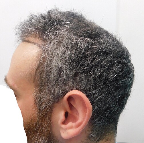 Result of Class 3V Patient – 3530 Grafts – HDC Hair clinic – Dr Maras photo