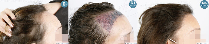 Dr. Jean Devroye, HTS Clinic / 3568 FUT (2695 + 873) / Female hairline restoration photo