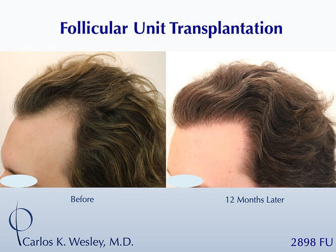 #BAM Hairline and Temples + a Light Crown Coverage (2898 FUT grafts): Carlos K. Wesley, M.D. (NYC & LA) photo