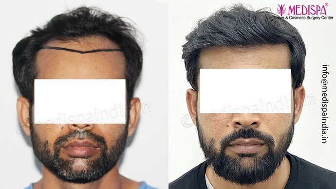 Dr. Suneet Soni - 3029 FUE Grafts, FUE Method (Trivellini System), NW - III photo