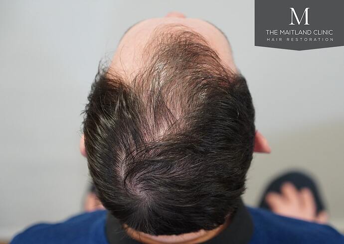 Dr Ball - The Maitland Clinic 1432 Grafts By FUE photo