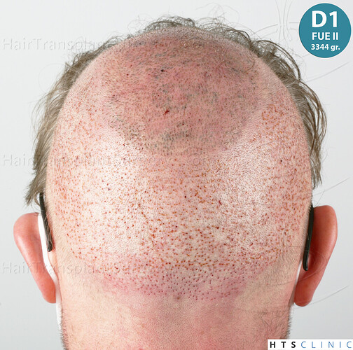 Dr. Jean Devroye, HTS Clinic / 6494 FUE-BHT (3150 + 3344) / NW VII, 2 sessions photo