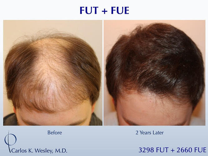 (Combined FUT 3298 & FUE 2660 grafts): Carlos K. Wesley, M.D. (NYC & LA) photo