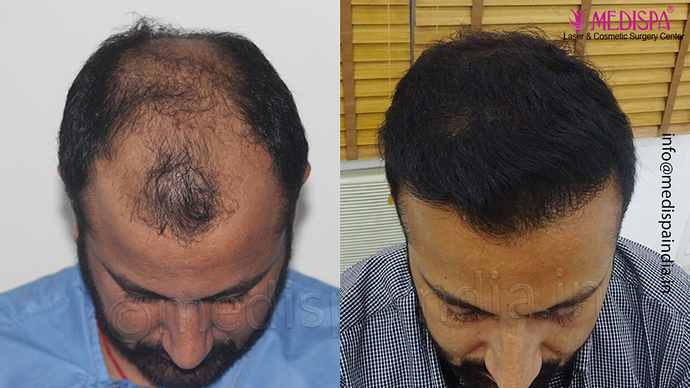 Dr. Suneet Soni - 5334 Grafts, Combine FUT + FUE + BHT (Beard) Technique, NW- V photo