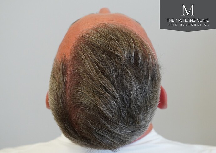 3487 grafts by FUE over 2 procedures photo