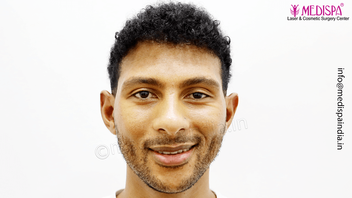 Dr. Suneet Soni - Afro Hair Transplant, 2 Sessions, 8355 Grafts, Combined FUT + FUE Technique, NW-VI, 5 Years Result photo