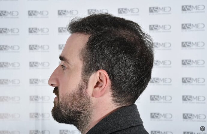 ASMED CLINIC CASE - DR.KORAY 5000 GRAFTS FUE photo