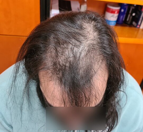 Density Enhancement Result for 4516 FUE Grafts – HDC Hair Clinic – 1 Year Post-Procedure photo