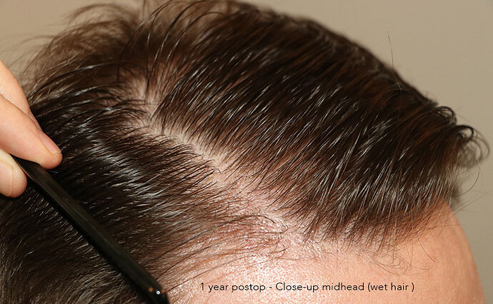 Case performed by Dr. Feriduni – 3322 FU in 1 procedure photo