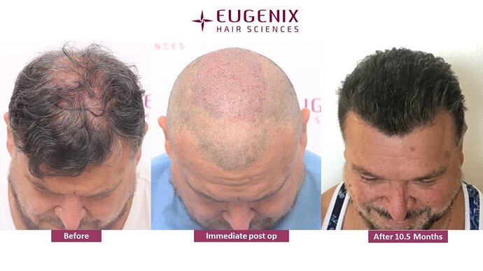 Hair Transplant in case of Diffuse thinning. photo