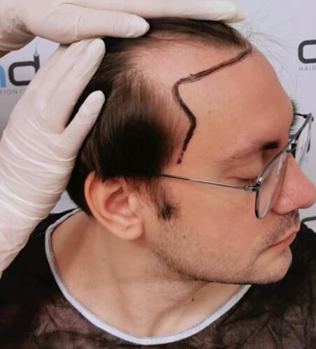 DR HAKAN DOGANAY/ 3600 GRAFTS / Implanter Pen+FUE photo