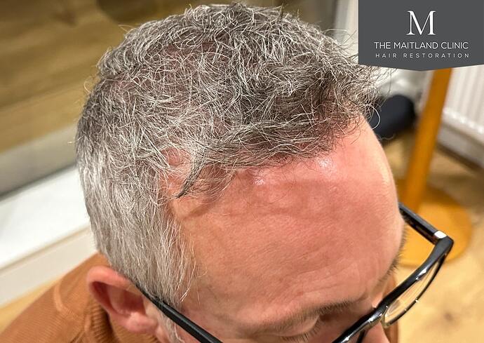 Dr Ball - The Maitland Clinic 2448 Grafts By FUT photo