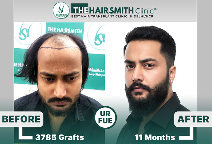 The HairSmith Clinic Delhi | NW Stage 6 | 3785 Grafts | 11 Months Hair Transplant Result photo