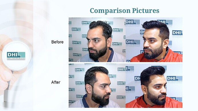 DHI India™ | NW 3 | 1,524 Grafts | Youthful Hairline Restored | DHI Hair Transplant photo