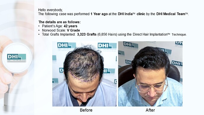 DHI India™ | NW 5 | 3,323 Grafts | 1 Year Hair Transplant Result photo