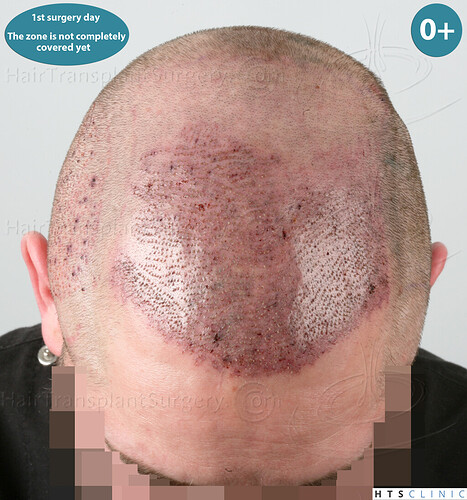 Dr. Jean Devroye, HTS Clinic / 3523 FUE / NW V, 1 session photo