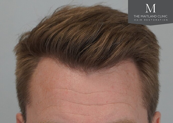 Dr Ball - The Maitland Clinic 1204 Grafts By FUE photo