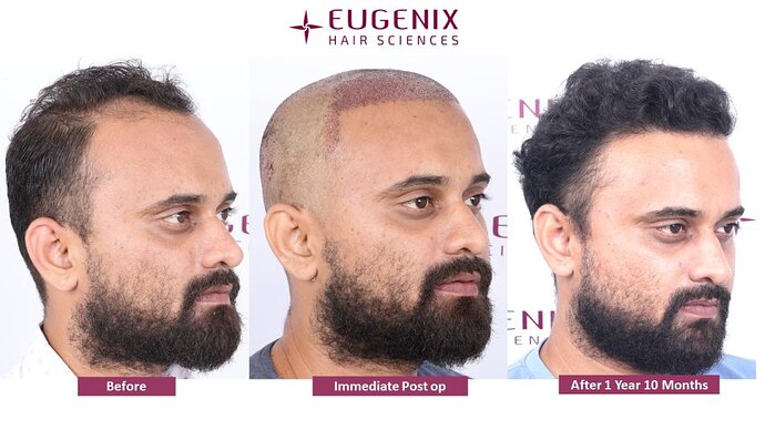 Eugenix Hair Sciences Clinic | Norwood Grade 3 | 22 Months Hair Transplant Results| photo