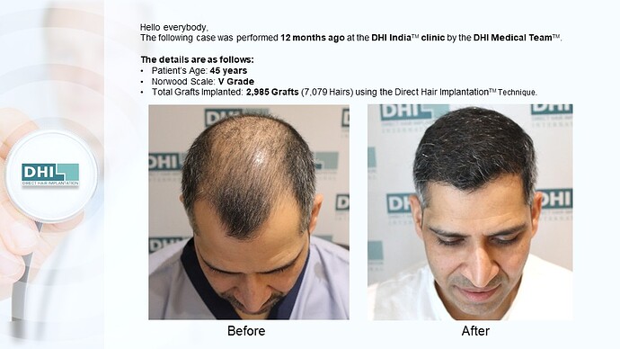DHI India™ | NW 5 | 2,985 Grafts | 12 Months DHI Hair Transplant Results photo