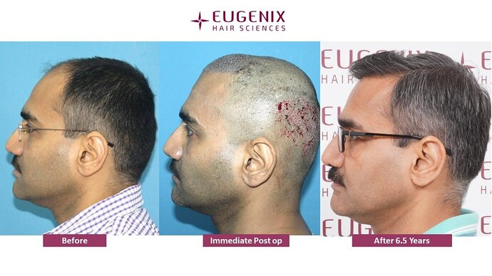 EUGENIX HAIR SCEINCES | GRADE 4 | 6 YEAR 5 MONTHS RESULT photo