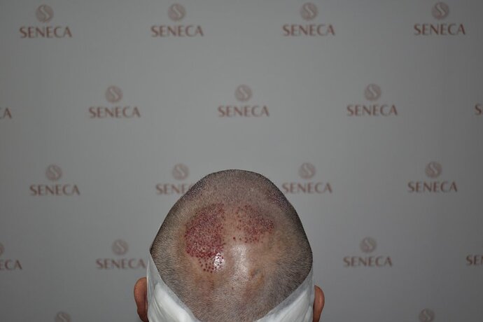 Sharing Tim Visser's Hair Transplant Journey at Seneca Medical Group photo