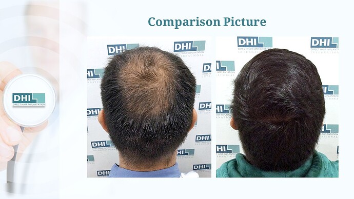 DHI India™ | Crowning Glory Restored | 2,650 Grafts | 8 Months Hair Transplant Result photo