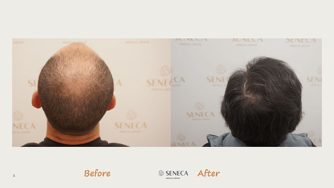 Seneca Medical Group - 3612 grafts with Direct Fue photo