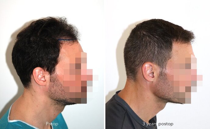 Case performed by Dr. Feriduni – 3255 FU in 1 procedure photo