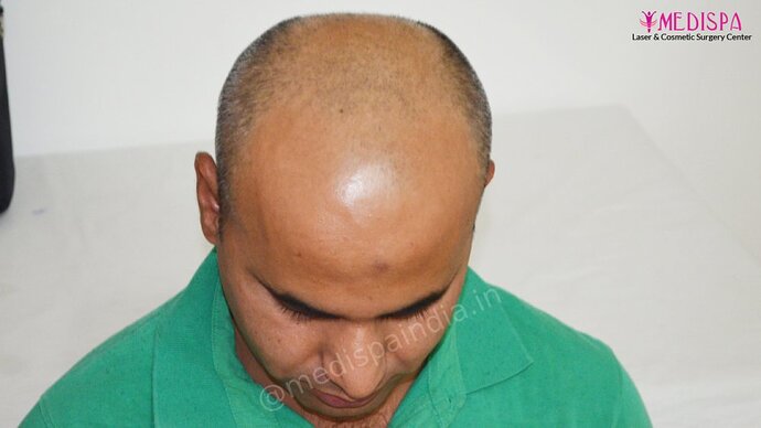 11600 Grafts in 3 FUT Sittings by Dr Suneet Soni photo