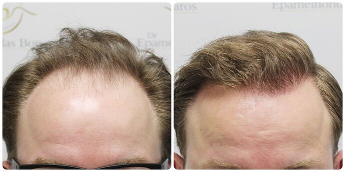 Dr Bonaros, Glasgow, UK / 4081 FUE grafts / 0-12 Months photo