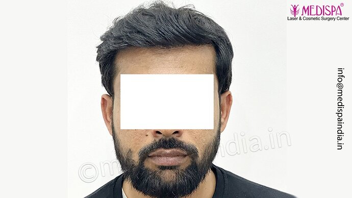 Dr. Suneet Soni - 3029 FUE Grafts, FUE Method (Trivellini System), NW - III photo