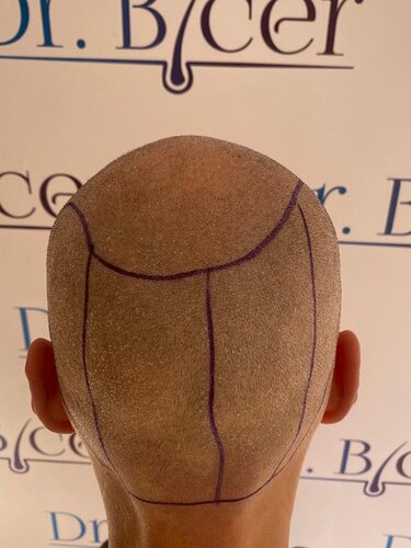 Ozlem Bicer MD-Hair Transplant-3770 Grafts FUE by micro-motor, 8. months result photo