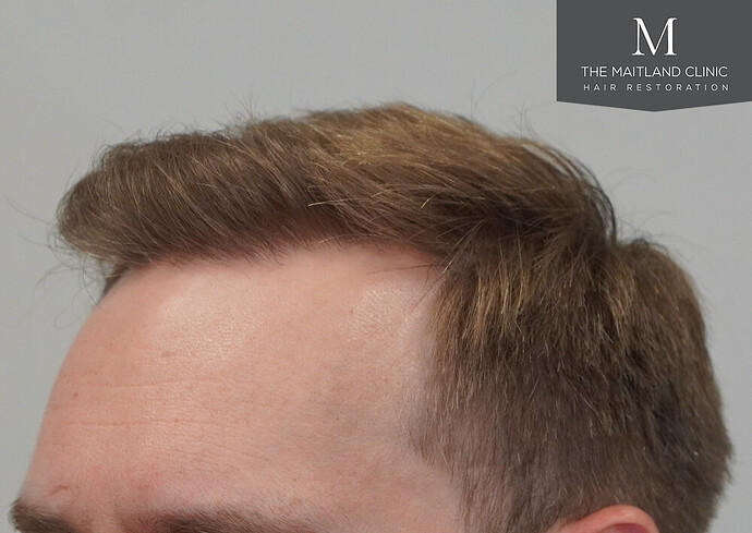 1826 grafts by FUE with Dr Edward Maitland Ball at The Maitland Clinic photo