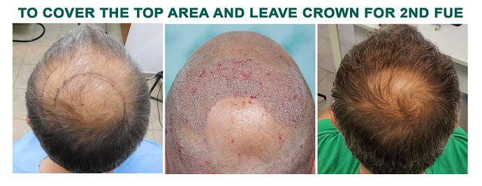 Result 3125 grafts – 10 months after – Top Coverage and Connecting top hair with side donor – HDC Hair Clinic – Dr Maras photo