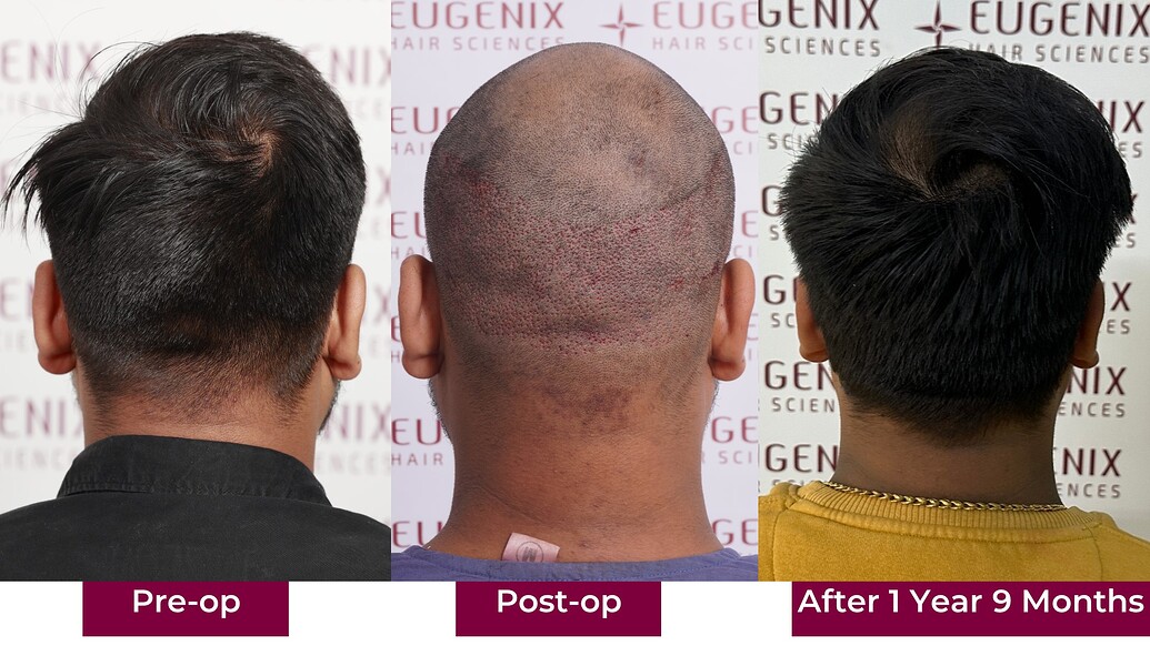 https://cdn.forumhairtransplant.com/optimized/3X/6/e/6ef96e0ff771da6d2c610e695f2e124bd5c07ddc_2_1035x582.jpeg